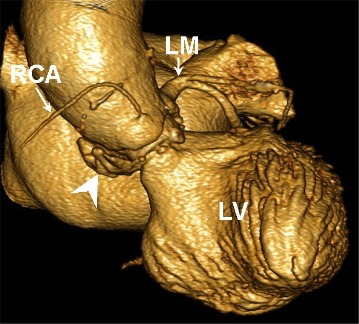 LVOT pseudoaneurysm imaged by MDCT